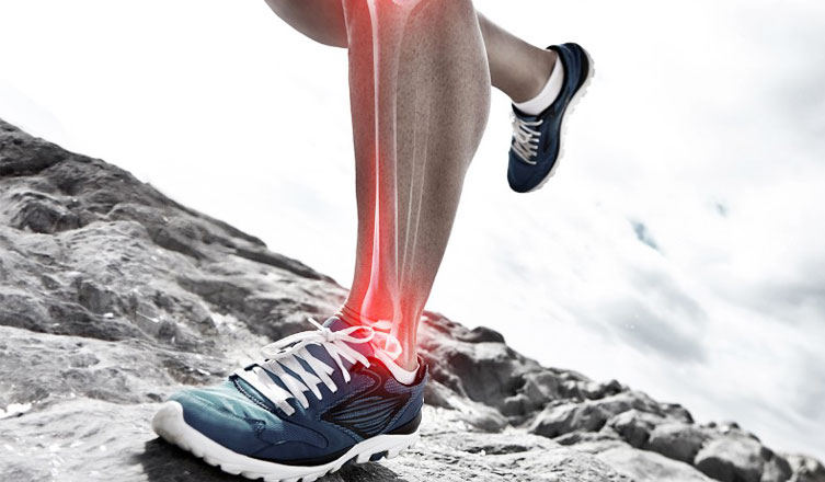 Shin Splints